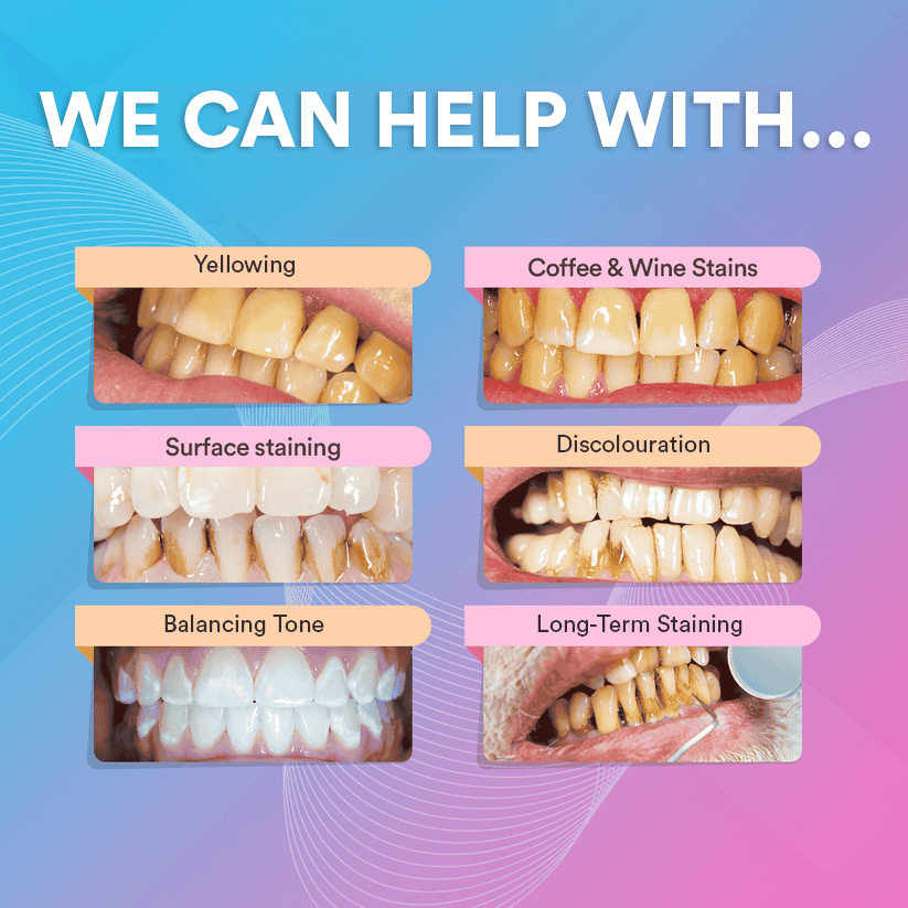 V34 Colour Corrector for Teeth: Cancels Yellow Tones, Safe Enamel Whitening, Easy Use, Dental Cosmetic Perfection DP7