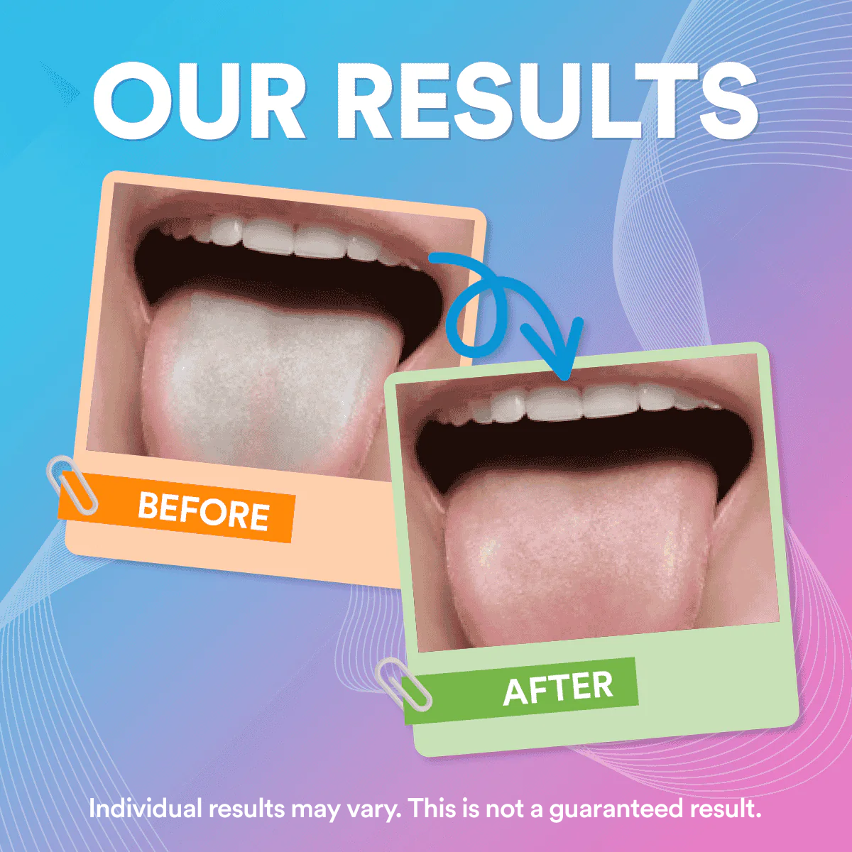 Stainless Steel Tongue Scraper | Smile Therapy