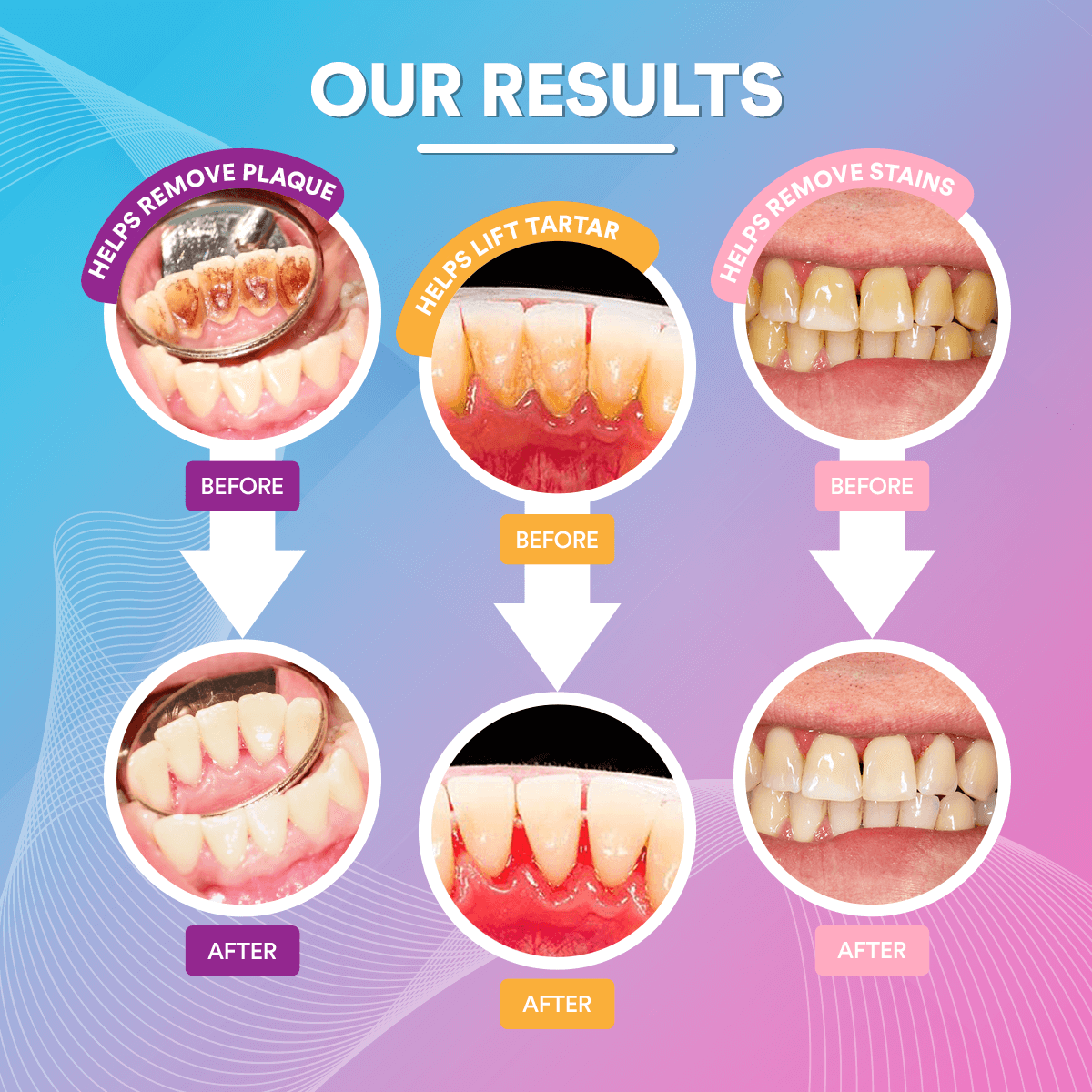 Ultrasonic Tooth Cleaner *BEST SELLER*