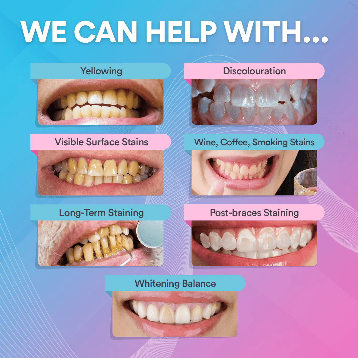 Advanced Teeth Whitening & Cleaning Strips (14 Treatments)