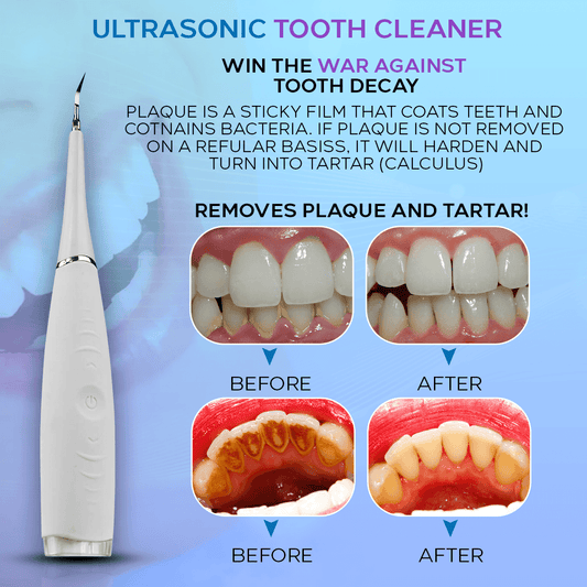 Ultrasonic Tooth Cleaner - Tooth Scraper - Smile Therapy