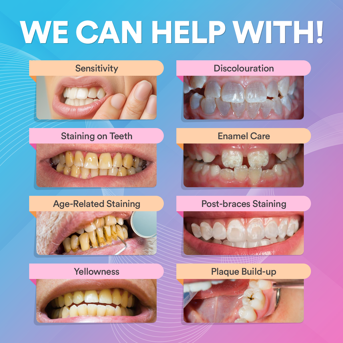 PAP+ Teeth Whitening Kit - With 6 Treatments